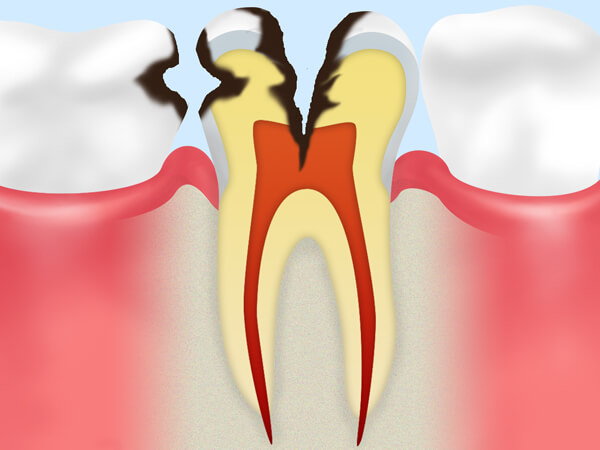 【C3】歯の神経のむし歯