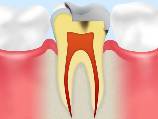 2：むし歯の再発リスクが低くなる