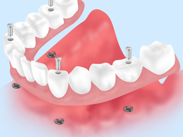 さくら歯科おおとり院のインプラント治療