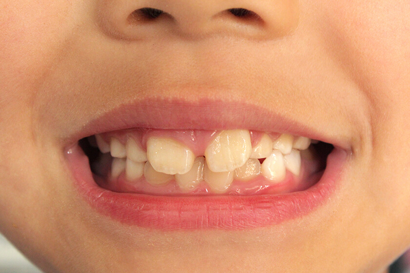 歯を失う原因をご存じですか？