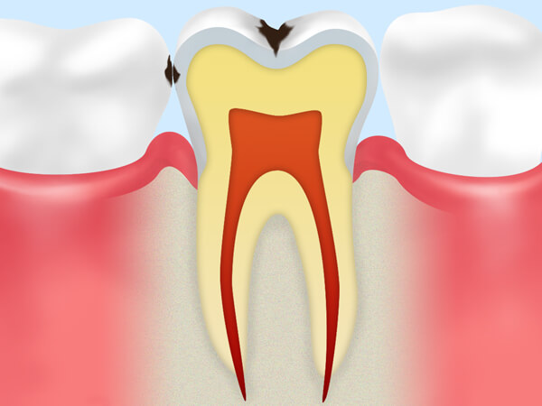 【C1】エナメル質のむし歯